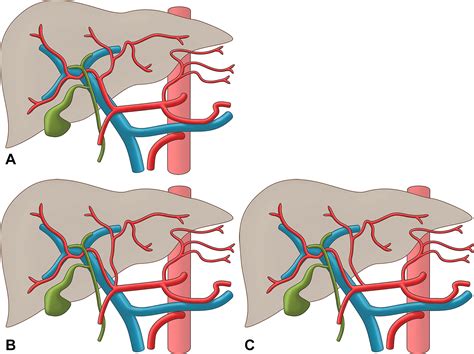 Anatomic Variations of the Hepatic Artery in 5625 Patients | Radiology ...