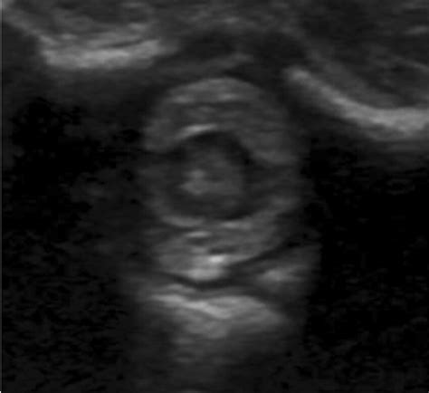 Occupation of the subarachnoid space by echogenic material that ...