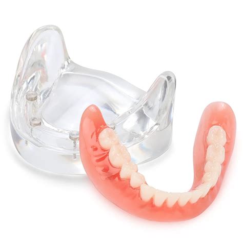 Amazon.com: faruijie Overdenture Model - Implant Overdenture Model ...