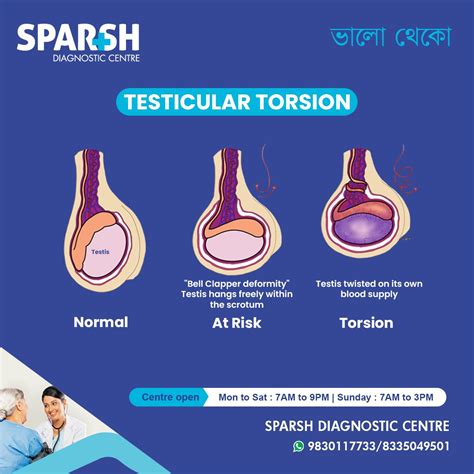 Testicular Torsion - Sparsh Diagnostic Center