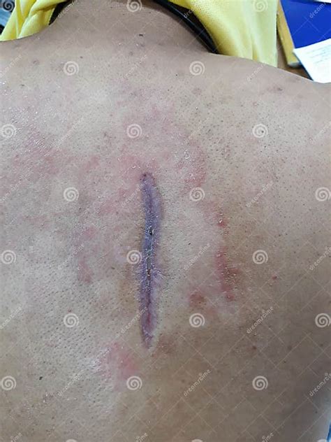 Image result for Giant Abscess Exploding On Back