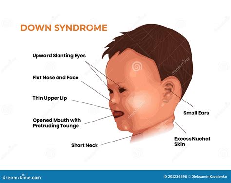 Face Features of the Baby with Down Syndrome. Trisomy 21 Symptoms Stock ...