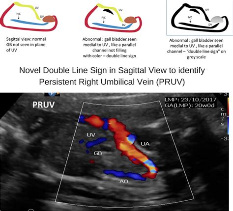 A Novel Double‐Line Sign in Axial and Sagittal View of Ultrasound of Fetal Abdomen to Identify ...