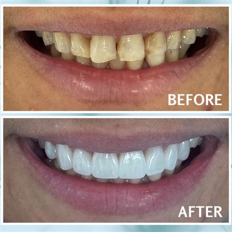 What Is a Composite Filling? Complete Guide | Riverview Dental