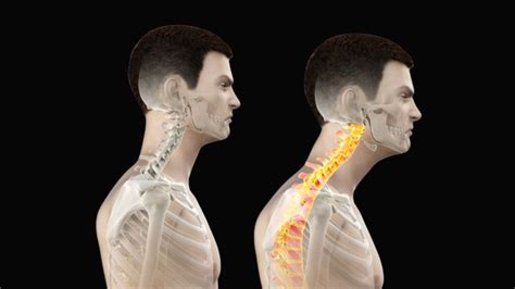 Image result for Forward Neck Position Tight Muscle Front