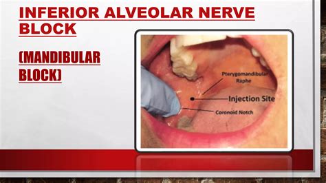 MANDIBULAR NERVE BLOCK TECHNIQUES | PPTX