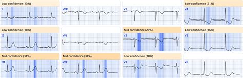 Image result for STEMI Cath Lab