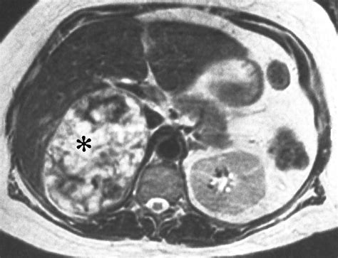 Large Degenerated Adrenal Adenomas: Radiologic-Pathologic ...