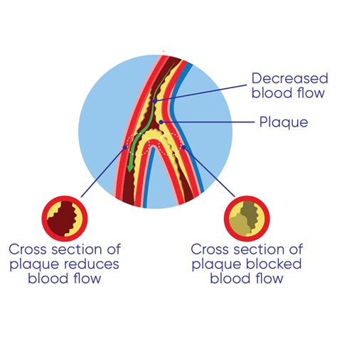 Ankle-Brachial Index Procedures Using Unit IX 的图像结果