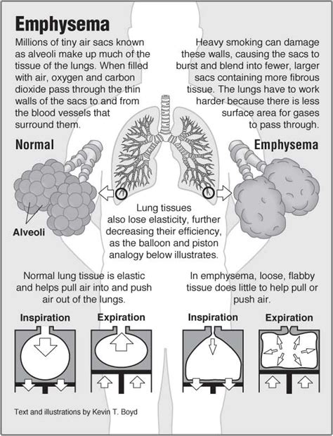 Image result for Emphysema Example