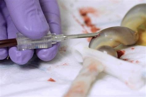 Bildergebnis für umbilical cord blood flow problems