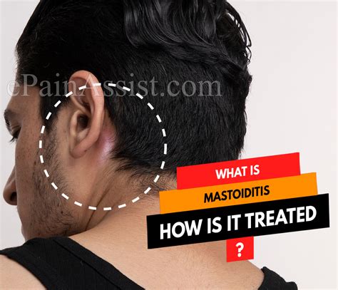 What is Mastoiditis & How is it Treated? | Causes, Symptoms, Prevention, and Complications of ...