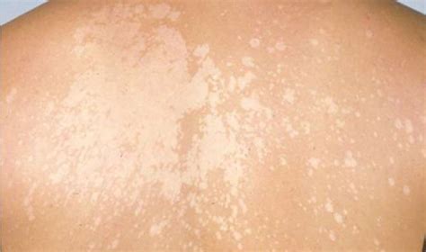 Skin Disorders With Pictures Symptoms and Treatments: स्किन पर दिखे इस ...