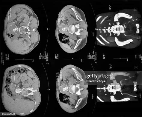 Normal Ct Scan Abdomen
