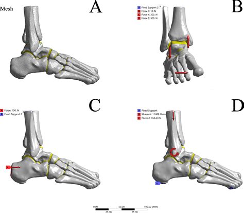 Anterior Talofibular Ligament Repair in Combination With Anterior ...