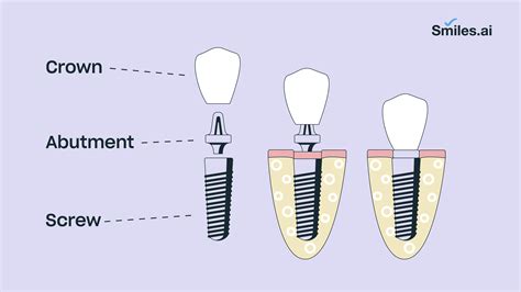 The Dental Implant Procedure – Explained Step by Step