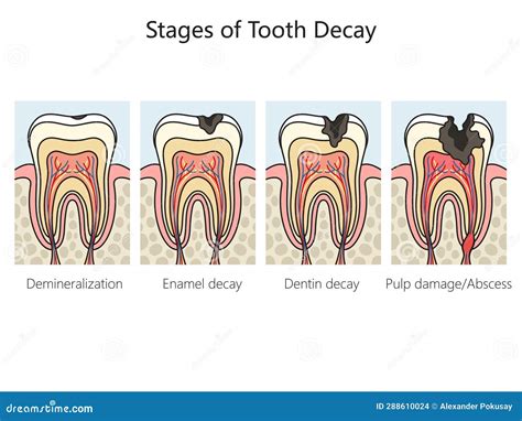 Tooth Decay Caries Stages Diagram Medical Science Stock Illustration - Illustration of ...