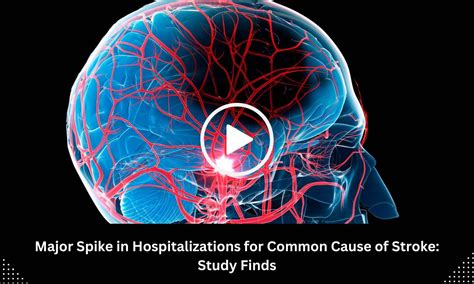 Cervical Artery Dissections Surge Nearly Fivefold in U.S. Over 15 Years ...