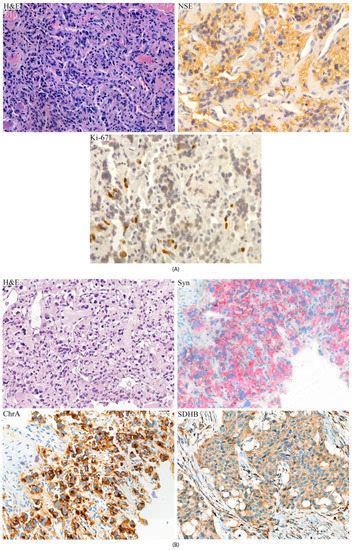 Comprehensive Genetic Study of Malignant Cervical Paraganglioma