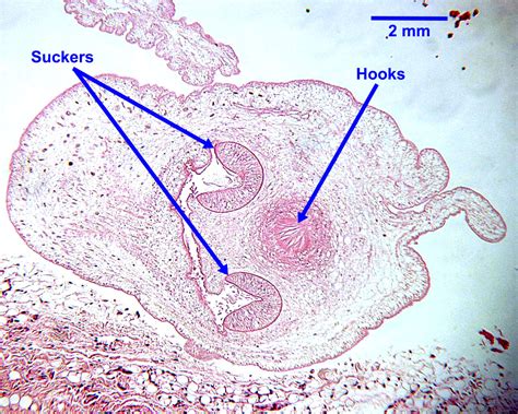 Taenia Solium Cysticercus