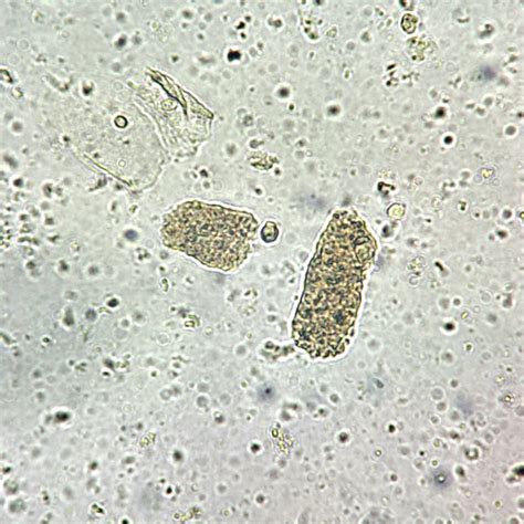 Urinary Casts: Identification & Significance