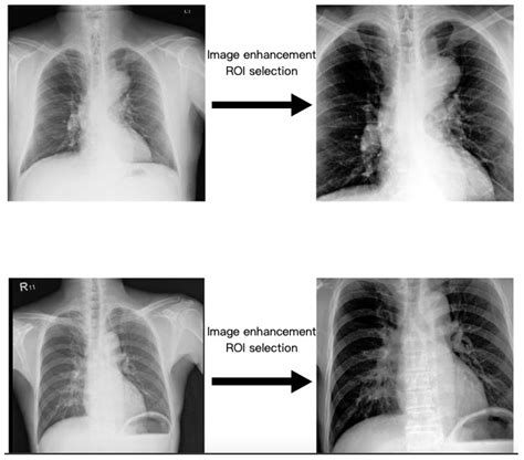 Thoracic Aortic Aneurysm Xray Thoracic Aortic Aneurysm Measured By