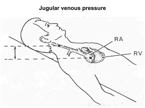 Jugular Venous Pressure (JVP) Jugular Venous Pulse | PPT