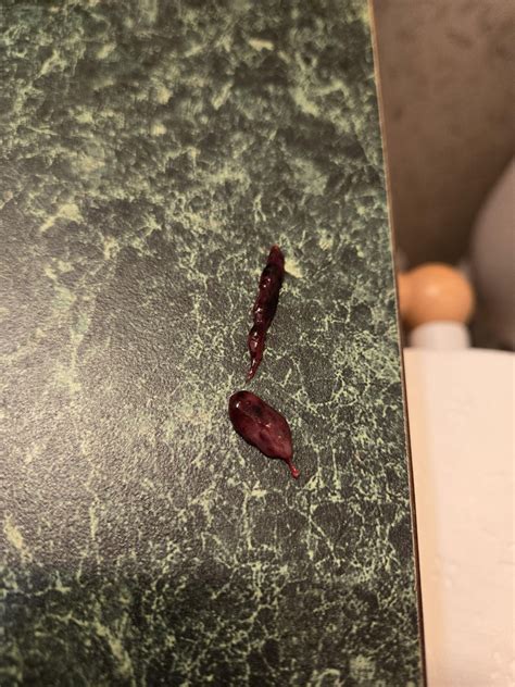 Decidual Cast? : r/Endo