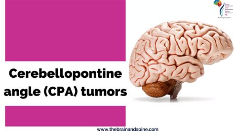Cerebellopontine angle (CPA) tumors - An Overview | PDF