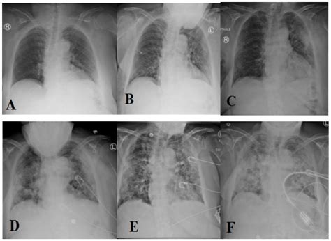 Recommender System for the Efficient Treatment of COVID-19 Using a ...