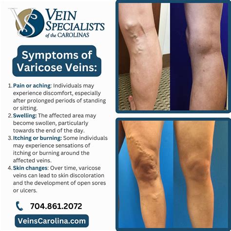 Varicose Veins Legs