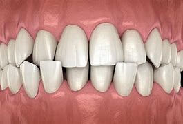 Image result for Malocclusion