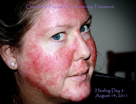 My Journey Through Topical Chemotherapy - Fluorouracil 5% Cream and Carac .5% Fluorouracil Cream ...