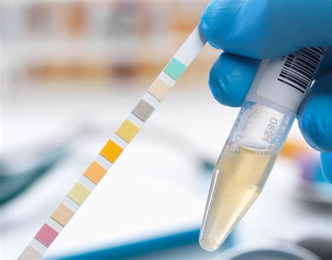 What Causes Elevated Ketones In Urine at Marina Williams blog