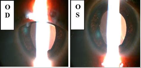 Image result for Transillumination Normal Head