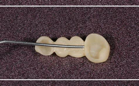 Homemade Dental Bridge 的图像结果