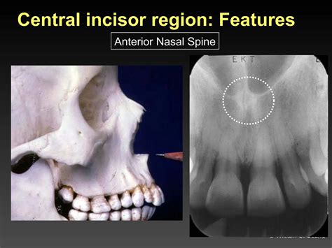 Dental Maxillary and Mandibular Anatomic Radiographic Landmarks.ppt