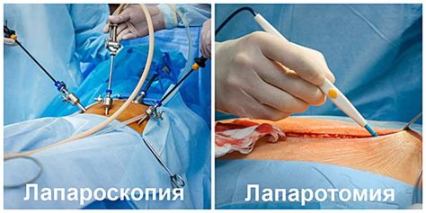 Восстановление после удаления кисты яичника: реабилитация после операции