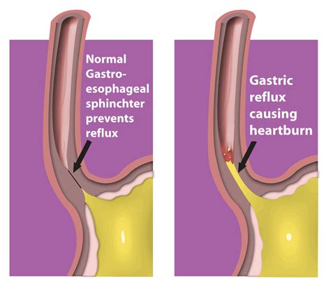 Tips To Manage Acid Reflux Now