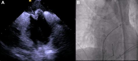 Successful Transseptal Puncture of Giant Atrial Septal Aneurysm With a ...