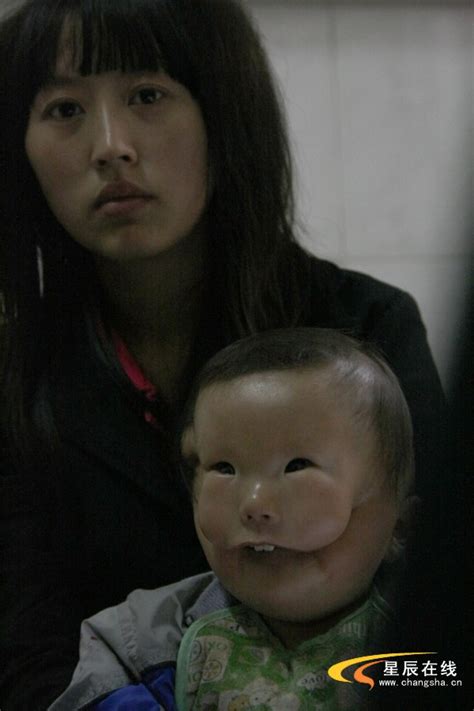 畸形婴儿成了极为罕见的“面具娃娃”(组图)_夹江吧_百度贴吧