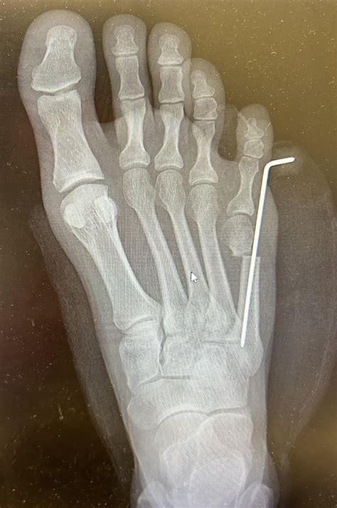 Tailors Bunion Xray Main Routes Of Infectious Spread. (a) Infectious