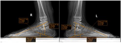 Grice Arthrodesis and Arthroereisis in the Surgical Management of ...