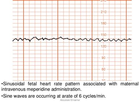 Cardiotocography: CTG antepartum and intrapartum
