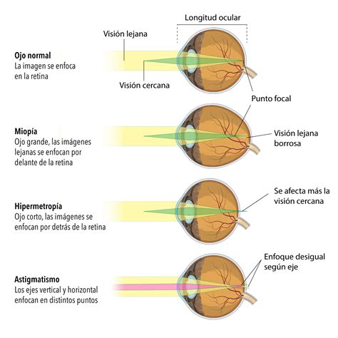 Miopia Y Astigmatismo