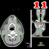 Radiotherapy | Targeting Cancer