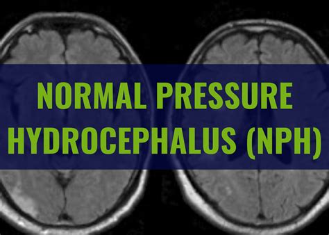 Normal Pressure Hydrocephalus (NPH) - Memory & Movement Charlotte
