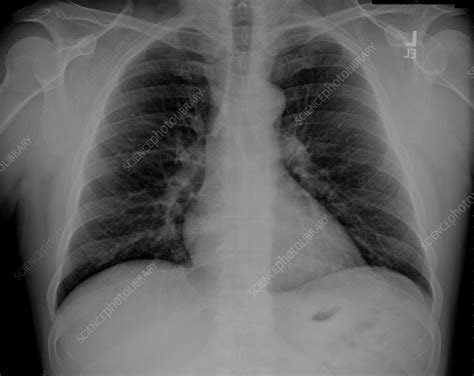 Image result for Normal X-ray