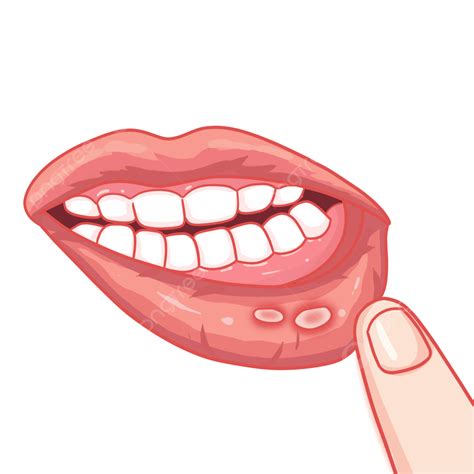 Mouth Ulcer In Infants