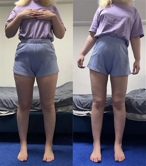 Before/After of Thigh + Love Handle Liposuction, Hip Dip Fat Grafting, 3 weeks post op (-12 cm ...